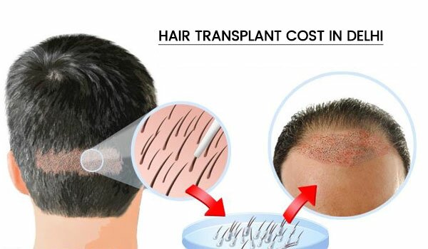 Hair Transplant Cost in Delhi,India
